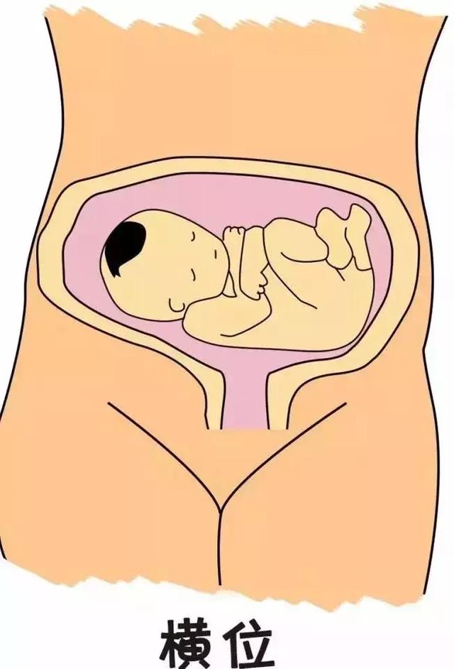 羊水多寡与胎儿大小,所以胎位不正的发生率,在不同妊娠周数并不相同