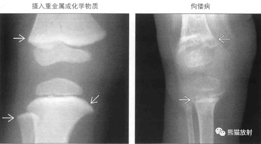 书摘丨儿童长骨及干骺端带和线