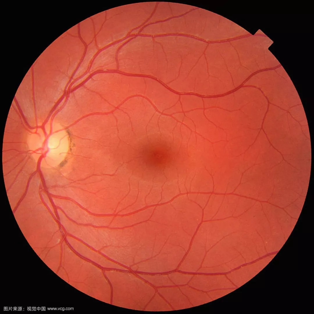 黄斑是个啥？听说高度近视患者更容易出现黄斑病变是真的吗？|黄斑|高度近视|病变_新浪新闻