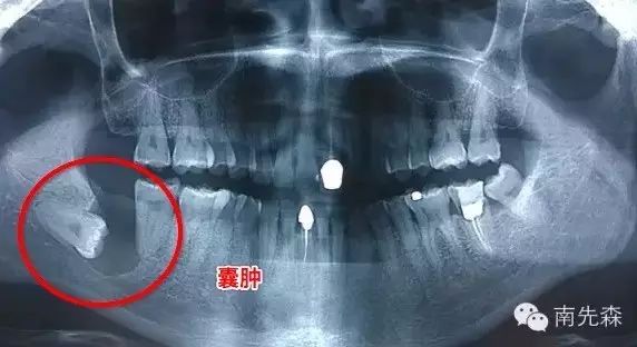 南先森遇到的真实病例智齿可以引起颌骨的萌出性囊肿,破坏颌骨,严重