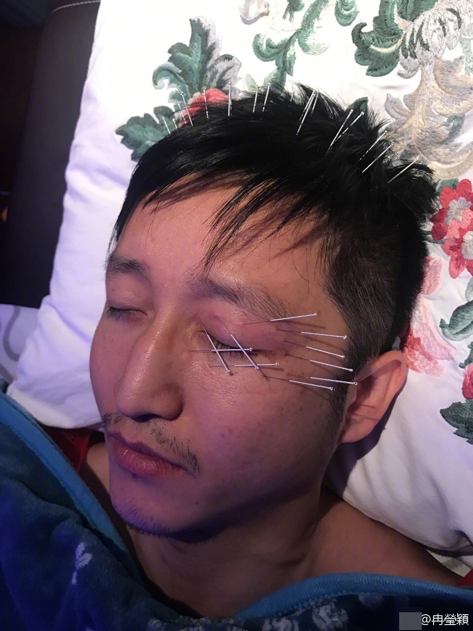 照片中邹市明左眼和头部扎满了针灸用的银针,相当令人心疼.