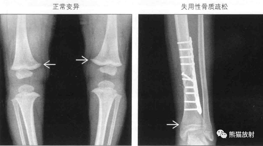 书摘丨儿童长骨及干骺端--"带"和"线"