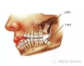 智齿冠周炎 是指第三磨牙(又称智齿)牙冠周围的软组织炎症.