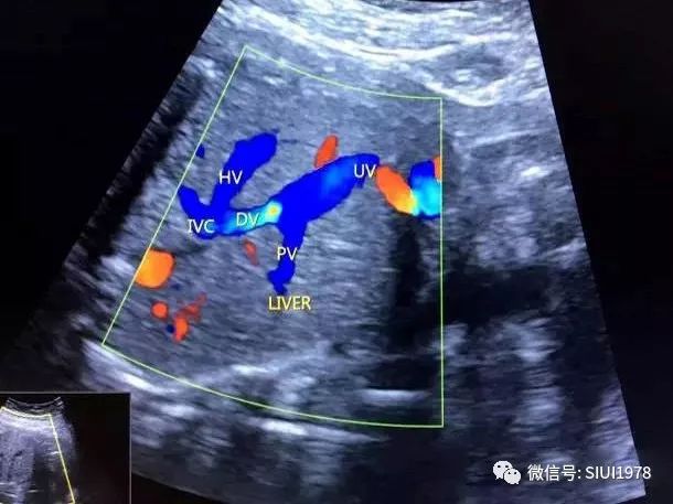 nt筛查时,怎样检查静脉导管?