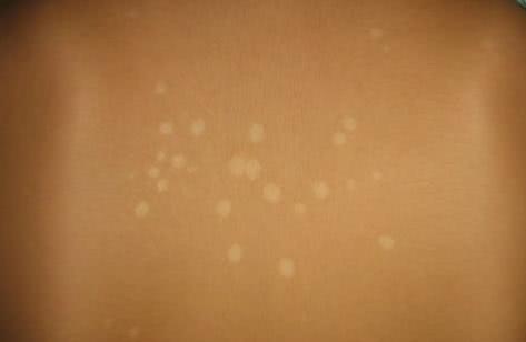 健康 正文  由马拉色菌感染引起的真菌性皮肤病.