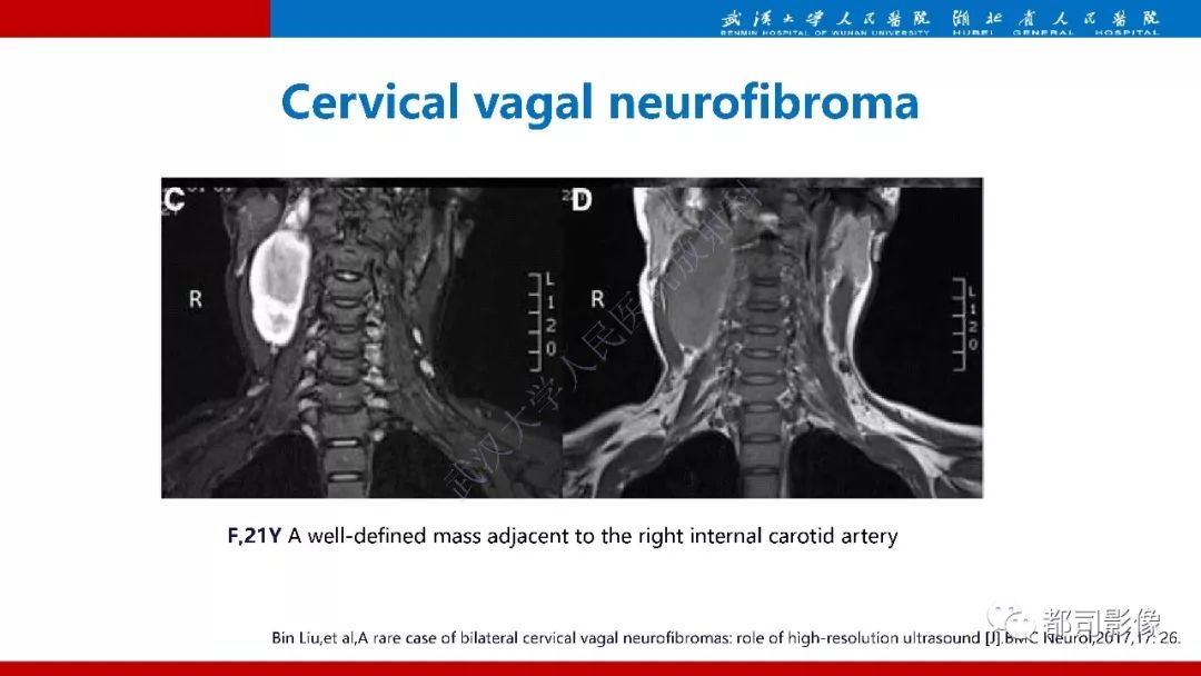 颈部神经鞘瘤影像诊断