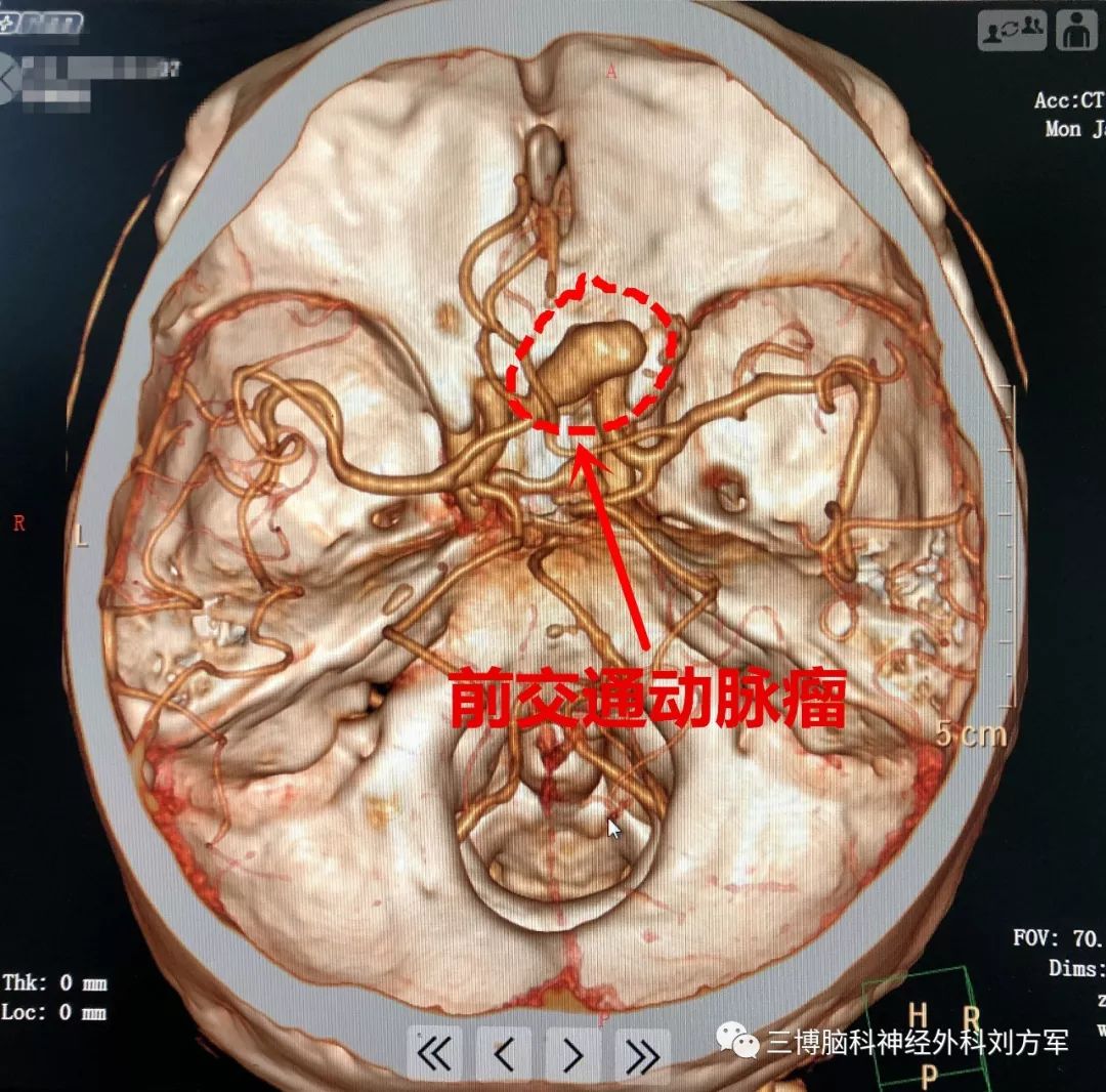 左侧翼点开颅前交通动脉瘤切除,载瘤动脉重建术