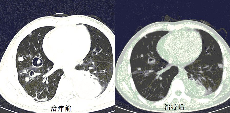 教你从肺ct上分辨是哪种细菌感染②丨肺炎克雷伯杆菌篇