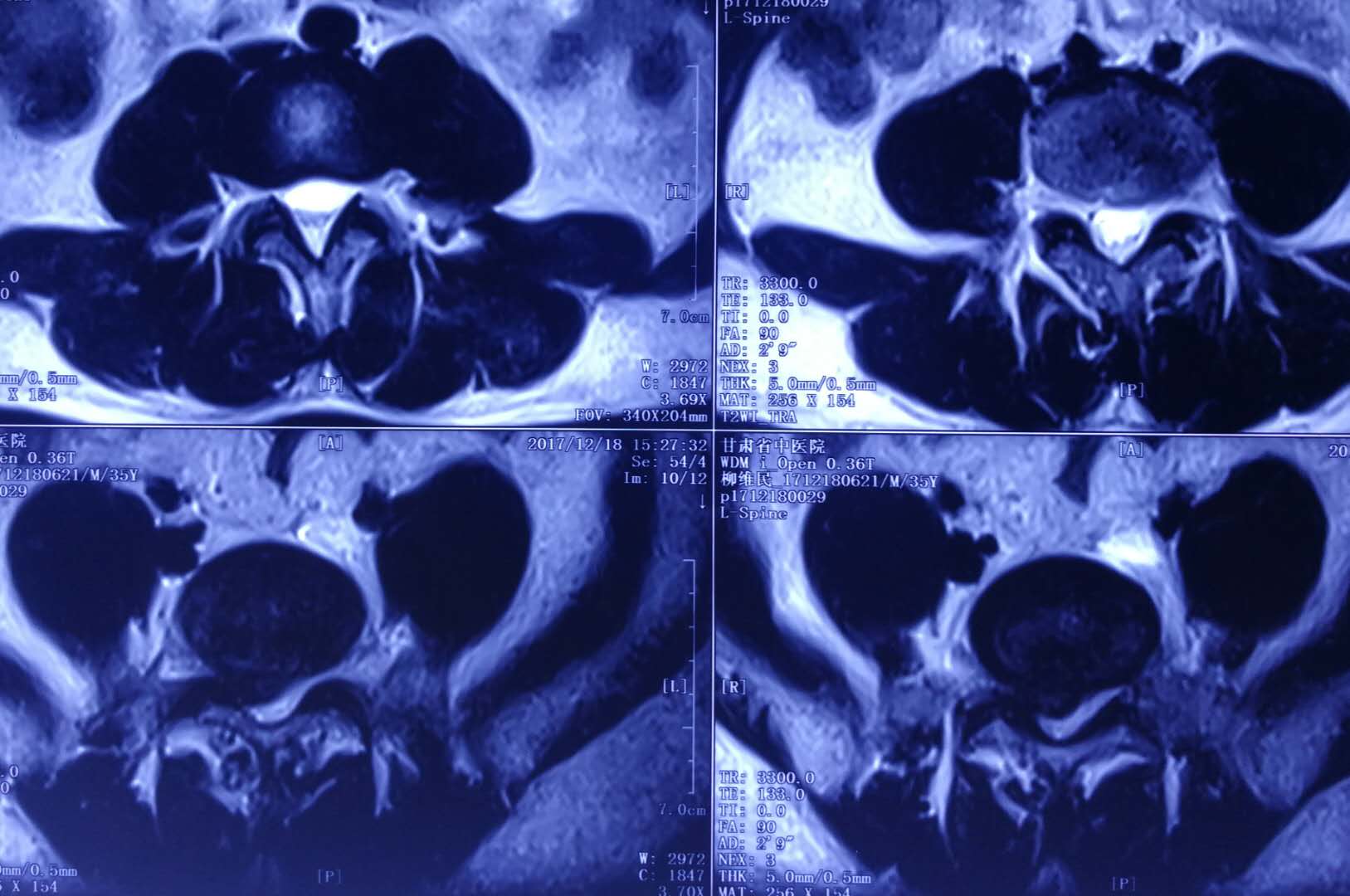 腰4/5椎间盘突出并椎管狭窄椎间植骨融合内固定术病例分享