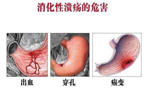 4种最常见胃溃疡症状!针对性治疗最关键 自测可看出你