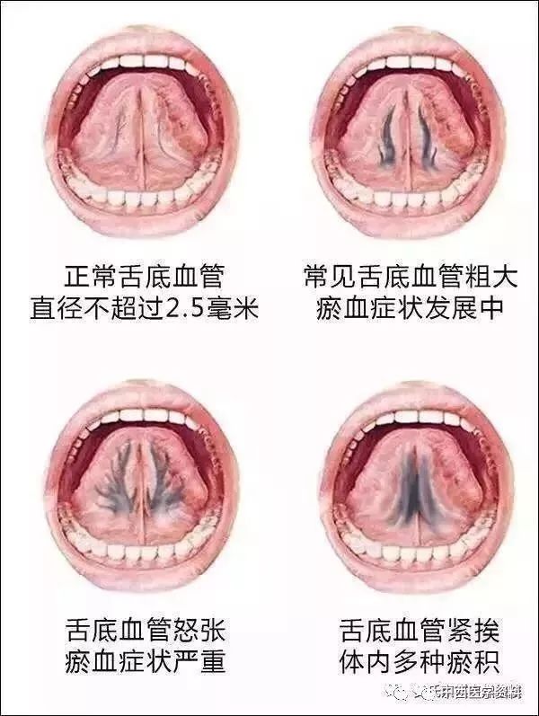 十人中有七八人能看到舌底或粗大,或分叉的舌底静脉.