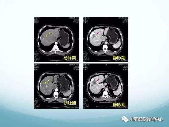 不要误诊为肝脏病变肝镰旁假病灶