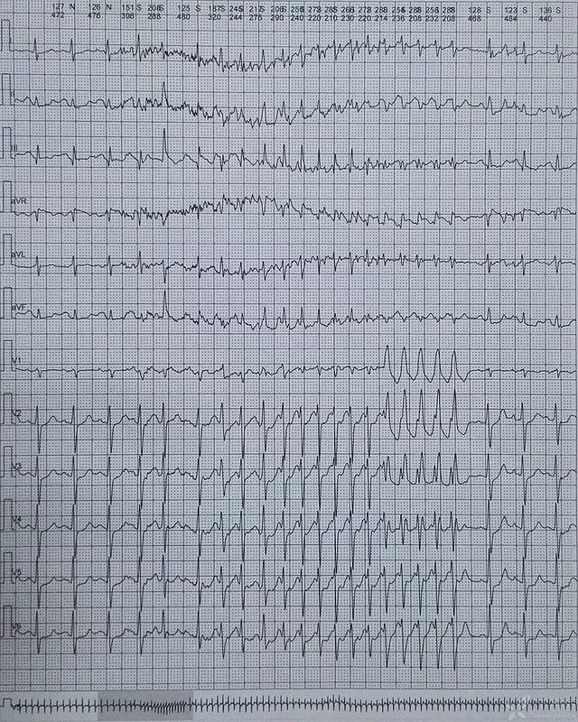 补充 holter 及正常心电图提问:你是如何考虑的?答案已公布,请先思考.