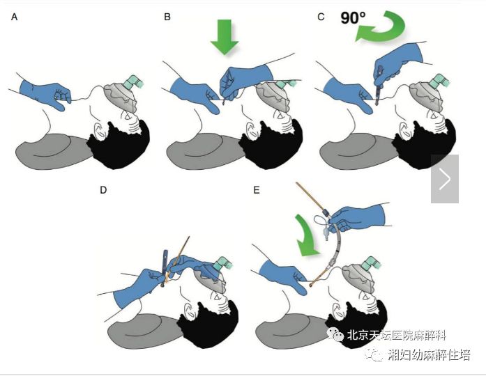 成人非预计困难气管插管管理指南