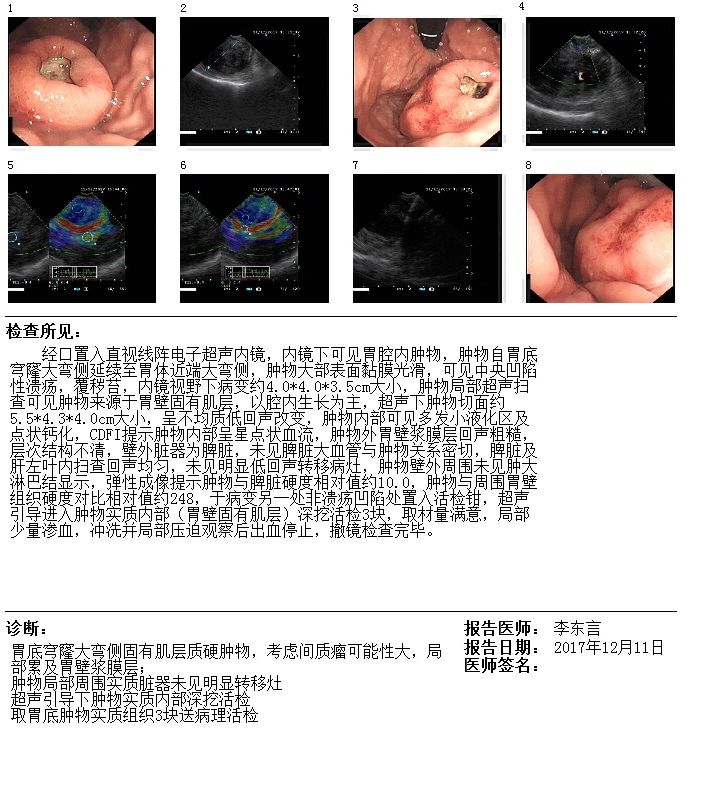 内窥镜对胃巨大间质瘤诊断意义的实例分析