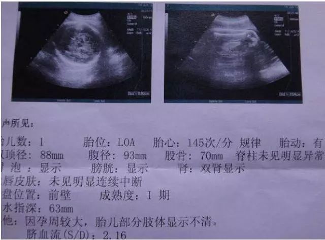 怀孕8个月肚子突然"变硬,医院检查后孕妇哭了,医生却笑了!