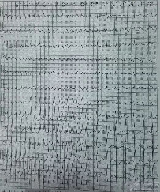 补充 holter 及正常心电图