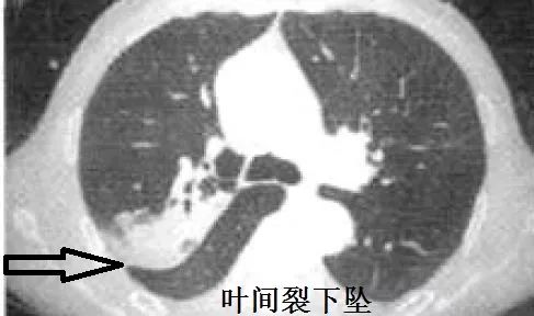 教你从肺ct上分辨是哪种细菌感染②丨肺炎克雷伯杆菌篇