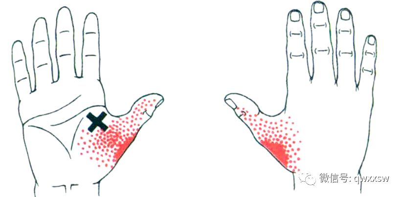 激痛点疗法—拇收肌