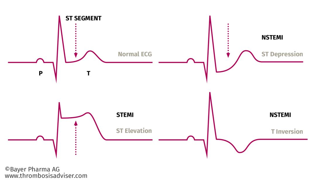 临床上根据心电图st段的变化特点将急性心肌梗死分为st段抬高型和非st
