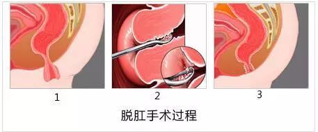 广东一小伙蹲坑"拉"出直肠!医生:他脱肛了!