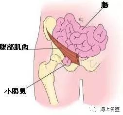 小肠气怎么办