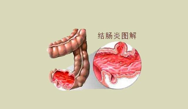 溃疡性结肠炎苦不堪言,传统中医治验方,方方有效