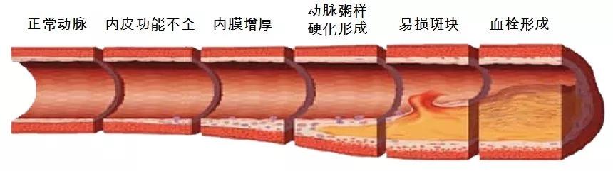 血栓分为:静脉血栓和动脉血栓两大类