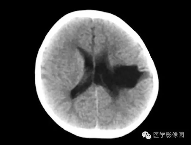 8种颅脑先天畸形ct诊断