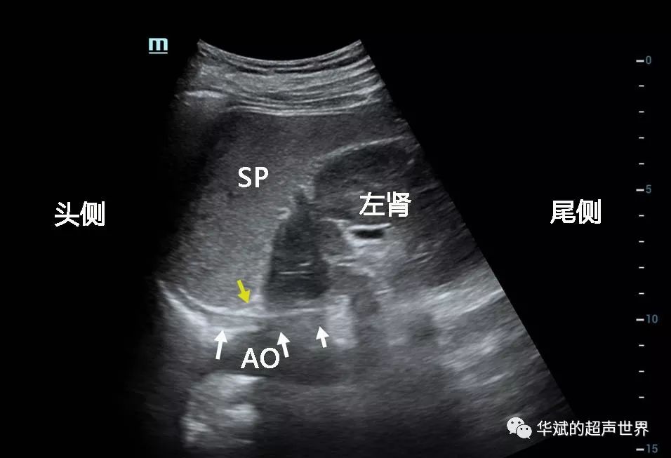 超声基础解剖:左侧肾上腺的扫查