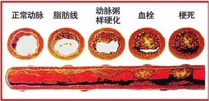 血管堵塞90%时,基本可认为这条血管被完全堵塞,甚至危及生命.