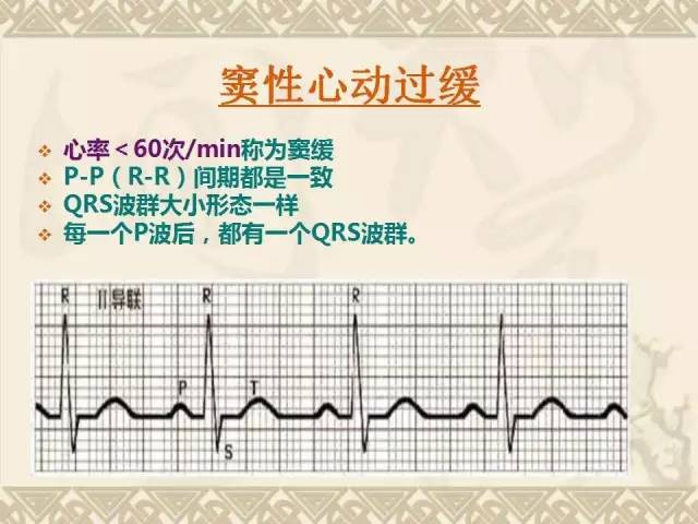 心电图简谱_正常心电图图片