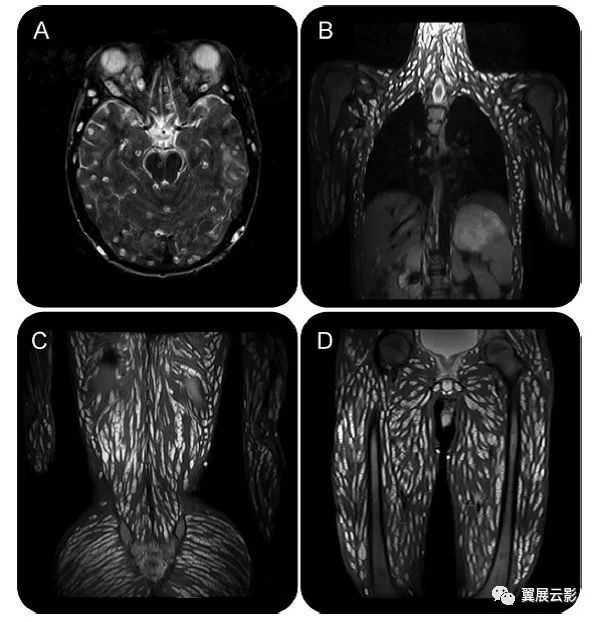 少见的全身播散性囊虫病,你都见过吗?