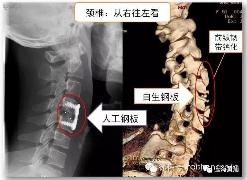 颈椎失稳,手术的方法治疗,会放入一块人工钢板来进行加固 骨质增生是