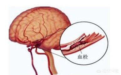 老年人中风怎么办