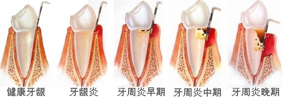 牙周病该如何护理你知道吗?