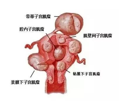 图一 :子宫肌瘤位置分类图