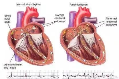 室颤vs房颤 | 急救各不同!