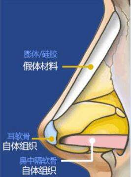 2,最常见的隆鼻手术—复合式假体隆鼻