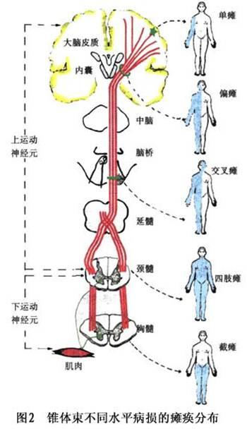 中医治疗运动神经元的优势——五龙荣肌汤