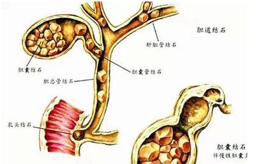 人为什么会有结石