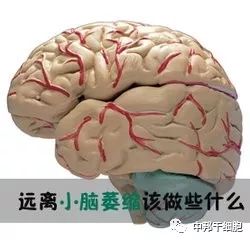 干细胞治疗小脑萎缩,从根源解决!