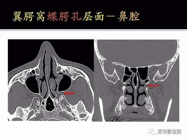 别再说难了,手把手教您学鼻腔鼻窦及颅底ct影像解剖丨