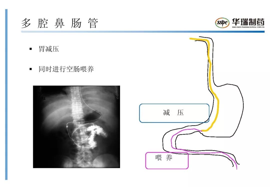 新版鼻胃管