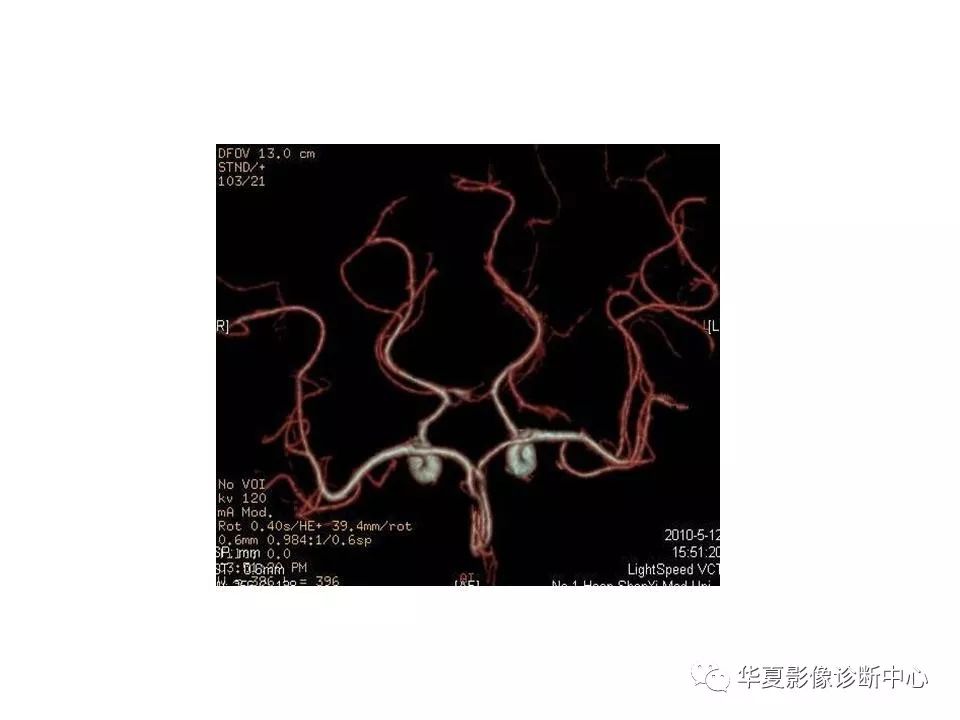 头颈部cta及头颈部血管常见变异