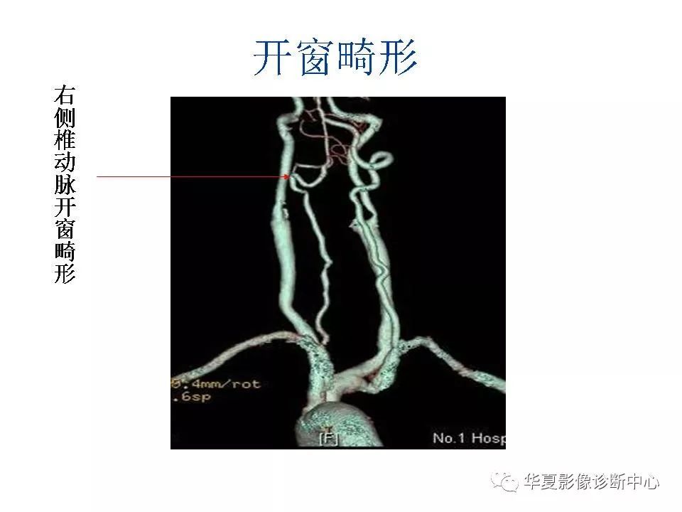 头颈部cta及头颈部血管常见变异