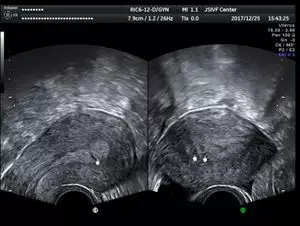 相比常规阴超,三维超声可以全方位,多切面,多角度来观察子宫内膜及宫
