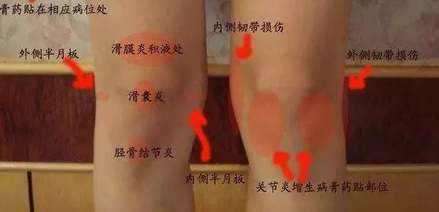 大腿关节有积液怎么办