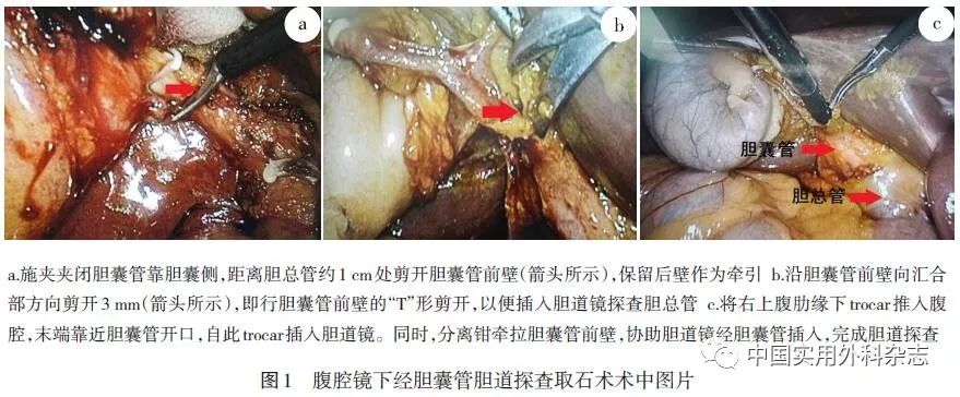 论著腹腔镜经胆囊管胆道探查取石术32例报告