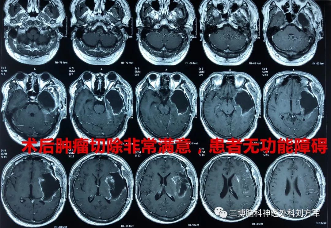 左侧额颞开颅颞叶胶质瘤切除术